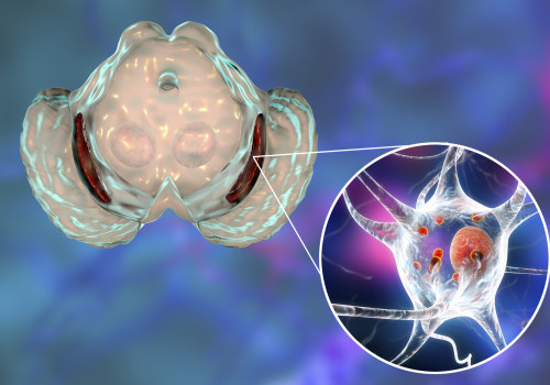 Levodopa for Parkinson's Disease: A Comprehensive Overview